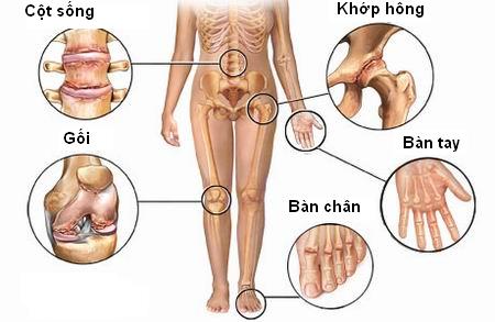 bệnh thoái hóa khớp