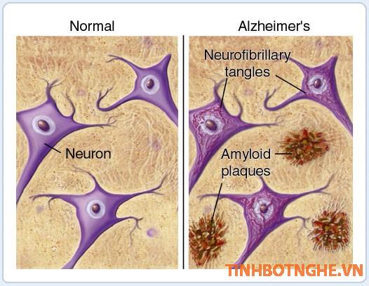 alzheimer và curcumin