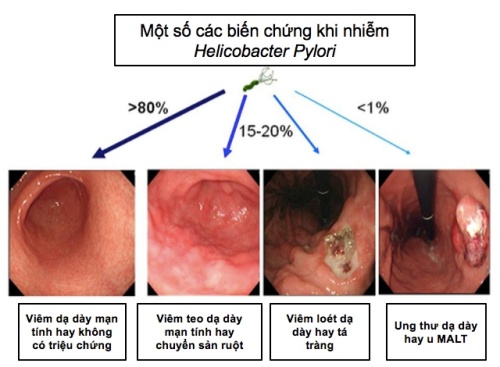 biến chứng khi nhiễm khuẩn hp