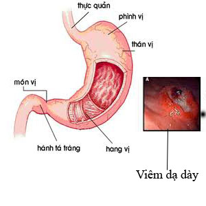 hang vị dạ dày