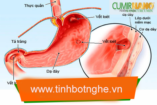 viêm loét dạ dày