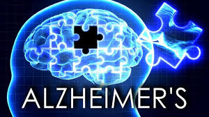 alzheimer