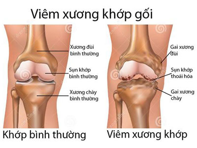 tinh bot nghe chua viem khop xuong