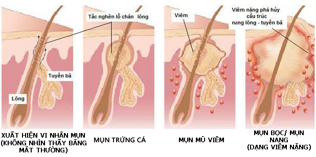 nguyên nhân gây mụn ở lứa tuổi dậy thì