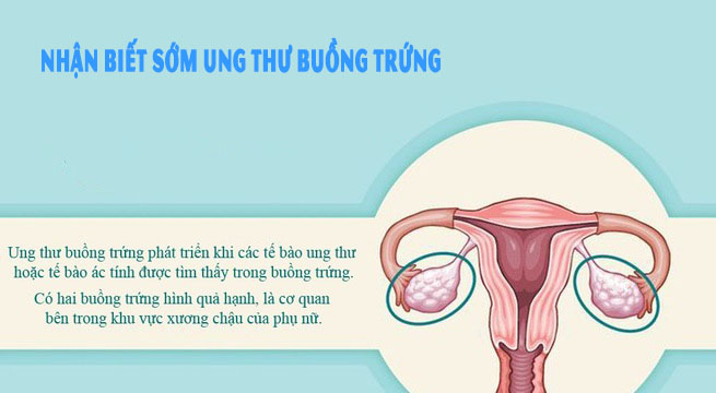 ung thư buồng trứng