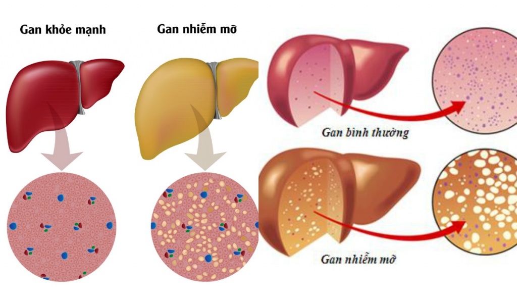 gan nhiễm mỡ