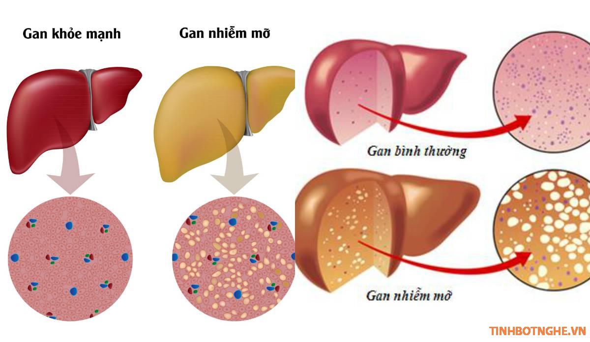 bệnh gan nhiễm mỡ