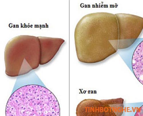 gan nhiễm mỡ