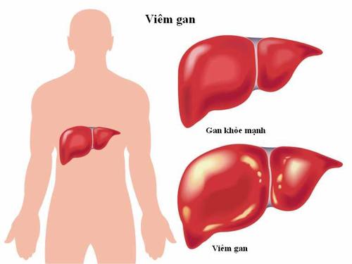 viêm gan b uống tinh bột nghệ