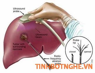 phòng ngừa bệnh ung thư gan